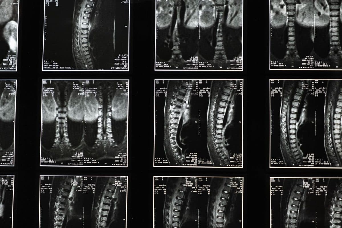 Spine Surgery
