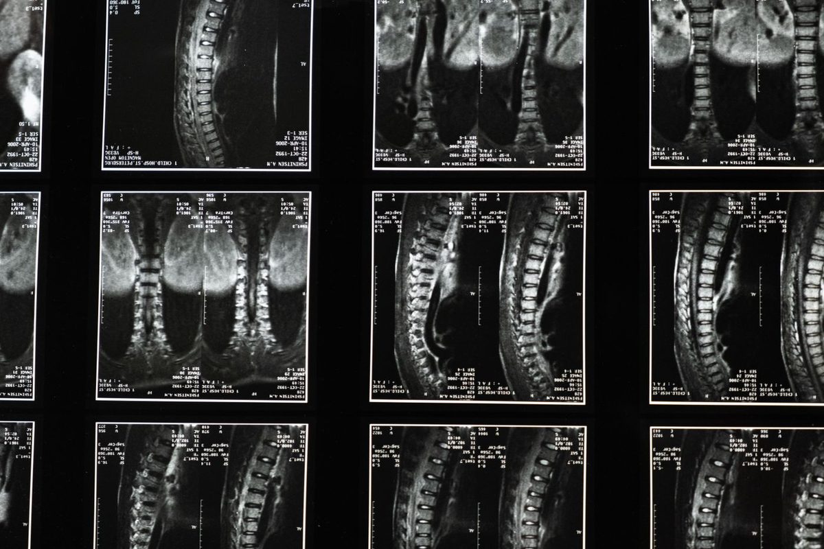 Spine Surgery